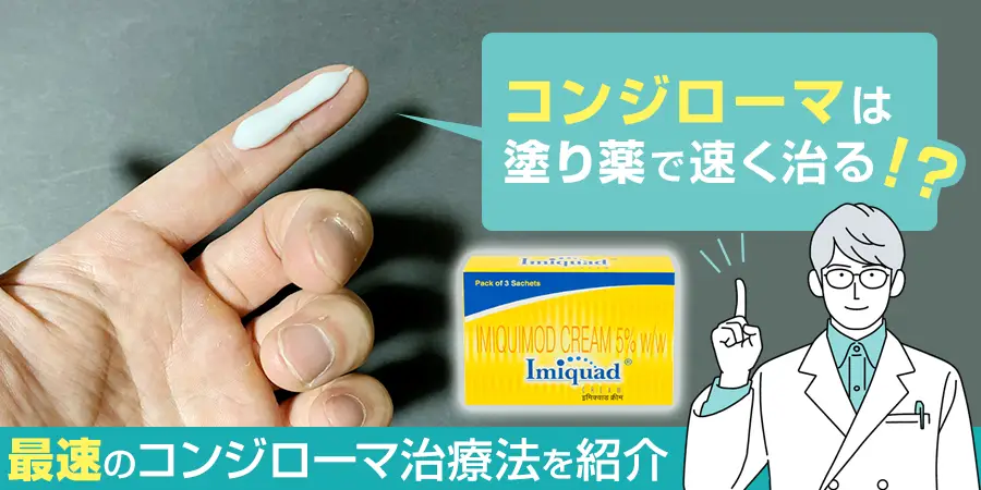 コンジローマの塗り薬を使えばどれくらいで治る？最速でコンジローマを治療する方法は？