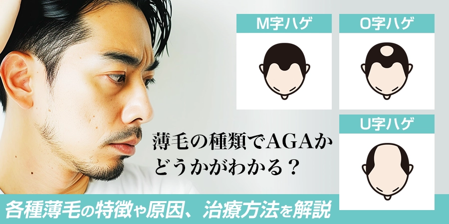 薄毛の種類でAGAかどうかがわかる？各種の特徴や原因、治療方法を解説