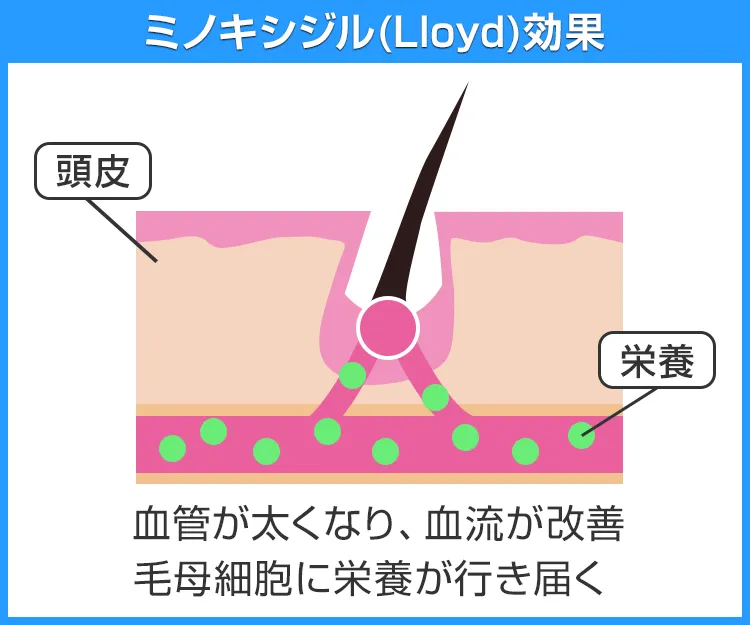 ミノキシジル(Lloyd)7