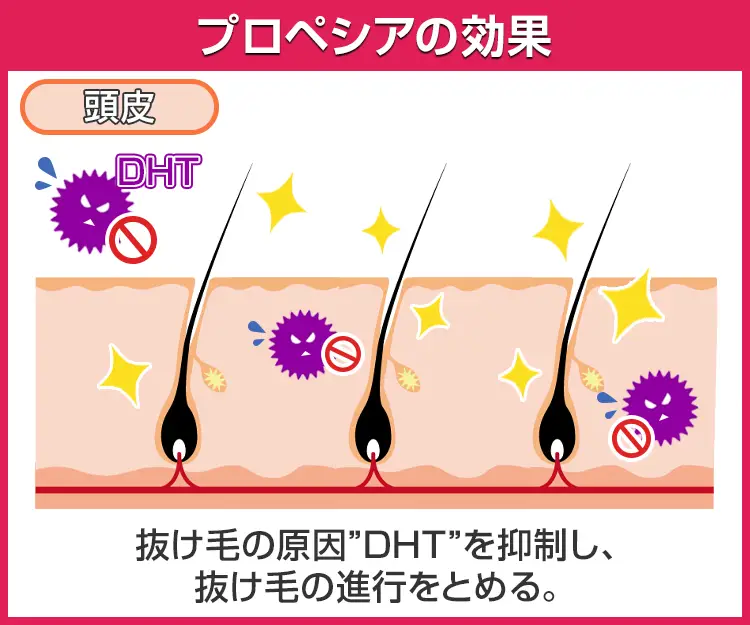 プロペシア3