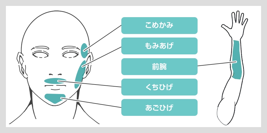 多毛症があらわれやすい部位